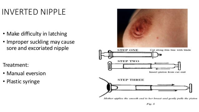 nipple piercing and breastfeeding problems 